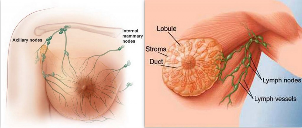 breast cancer treatment