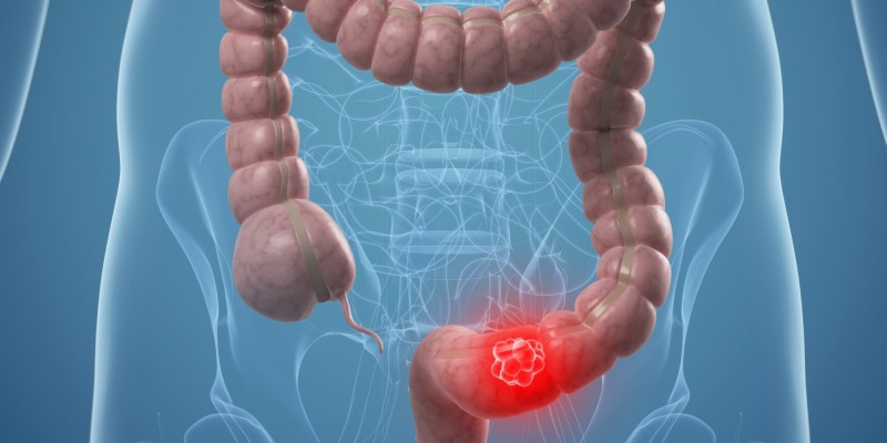 colon cancer