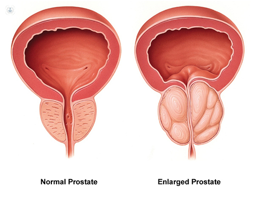 Prostate Cancer Symptoms