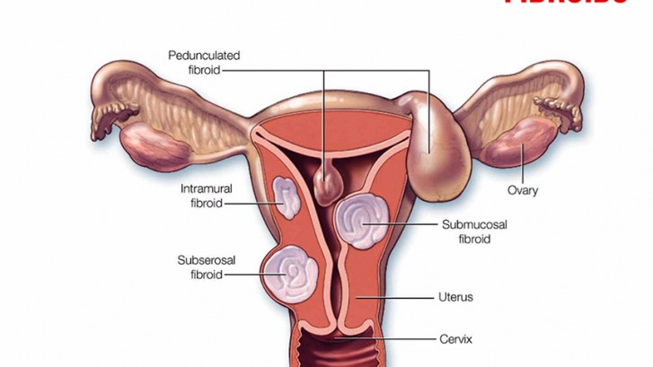 fibroid