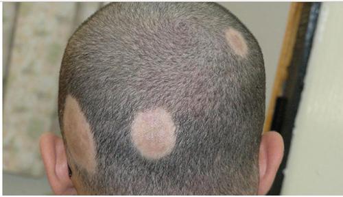 alopecia areata treatment